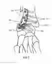 Fig. 04 - Tibia-talus-calcaneus (T-T-C) locking plate