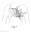Fig. 02 - DEVICE FOR THE DEFIBRILLATION OF THE HEART