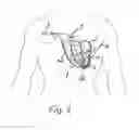 Fig. 07 - DEVICE FOR THE DEFIBRILLATION OF THE HEART