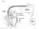 Fig. 01 - Sustaining ventricular tachycardia detection