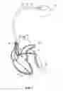 Fig. 02 - Implantable systems and method for use therewith for tracking changes in hemodynamics and cardiac disease