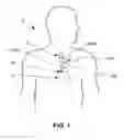 Fig. 02 - Neurostimulation Based On Glycemic Condition