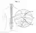 Fig. 07 - METHODS AND APPARATUS FOR SPINAL CORD STIMULATION USING EXPANDABLE ELECTRODE