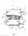 Fig. 02 - Universal Spinal Disc Implant System
