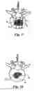 Fig. 07 - Bone grafts