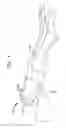 Fig. 02 - System and method for joint resurfacing with dynamic fixation