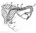 Fig. 01 - System and method for occluding a reproductive body lumen