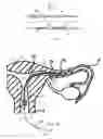 Fig. 05 - System and method for occluding a reproductive body lumen