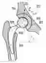 Fig. 01 - Wear-reducing geometry of articulations in total joint replacements
