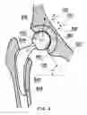Fig. 07 - Wear-reducing geometry of articulations in total joint replacements