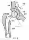 Fig. 08 - Wear-reducing geometry of articulations in total joint replacements