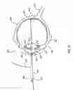 Fig. 04 - Orthovoltage radiotherapy
