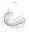 Fig. 02 - Method for producing an orthodontic appliance having a vibrating element