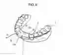 Fig. 07 - Method for producing an orthodontic appliance having a vibrating element