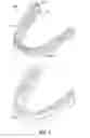 Fig. 02 - Dental appliance with resilient portion