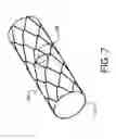 Fig. 10 - Branched Stent Delivery System