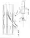 Fig. 15 - Branched Stent Delivery System