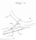 Fig. 21 - DEVICES AND METHODS FOR LIGATING ANATOMICAL STRUCTURES
