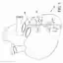 Fig. 02 - Endovascular device with a tissue piercing distal probe and associated methods