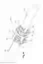 Fig. 21 - Dynamic fixation system