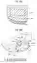 Fig. 83 - System and Method for Joint Resurface Repair