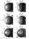 Fig. 02 - Methods for protecting eyes against neurodegeneration caused by glaucoma in age-related hereditary glaucoma using radiation