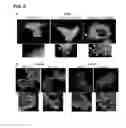 Fig. 09 - PAXILLIN MUTATIONS, METHODS OF ASSESSING RISK OF METASTASIS AND METHODS OF STAGING TUMORS