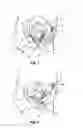 Fig. 02 - Method and apparatus for treating a prolapse related condition