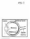 Fig. 04 - Soft tip cannula and methods for use thereof