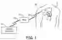 Fig. 02 - Method and apparatus for determining a respiration parameter in a medical device