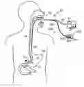 Fig. 01 - RIGIDIZABLE SURGICAL INSTRUMENT