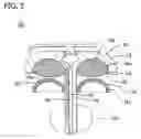Fig. 06 - Medical device having prefilled balloon