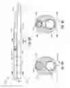 Fig. 06 - Guidewire replacement device