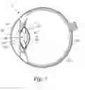 Fig. 04 - LASER MODIFICATION OF INTRAOCULAR LENS