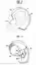 Fig. 02 - Cable length adjustment in auditory devices