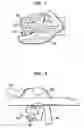 Fig. 05 - Cable length adjustment in auditory devices