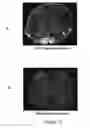 Fig. 14 - TrkB Agonists for Treating Autoimmune Disorders