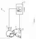 Fig. 02 - Accurate detection of sleep-disordered breathing