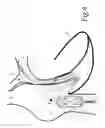 Fig. 06 - Device for supporting the heart and circulatory system