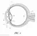 Fig. 02 - Ocular implant with anchoring mechanism and multiple outlets