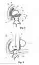 Fig. 03 - Postoperative Adhesion Prophylactic
