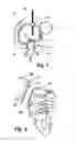 Fig. 04 - Postoperative Adhesion Prophylactic