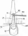 Fig. 01 - ORTHODONTIC POWER ARM
