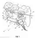 Fig. 02 - CORRECTOR ASSEMBLY WITH A TELESCOPABLE PORTION, A CRIMPABLE PORTION, AND AN ENGAGING PORTION, AND A RELATED METHOD