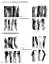 Fig. 22 - Compositions and methods to prevent cancer by stabilizing P53 through non MDM2-mediated pathways