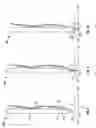 Fig. 05 - Needle-electrode and tissue anchor system