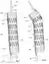 Fig. 07 - Curvable stent-graft and apparatus and fitting method