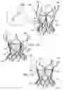 Fig. 02 - Prosthetic valve having tapered tip when compressed for delivery