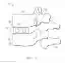 Fig. 02 - HYBRID INTERVERTEBRAL SPINAL IMPLANT