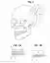 Fig. 02 - Craniotomy closure systems